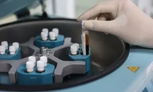 Gan nhiễm mỡ tăng nguy cơ tiền đái tháo đường